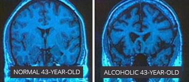 酗酒者和非酗酒者的大脑扫描图
